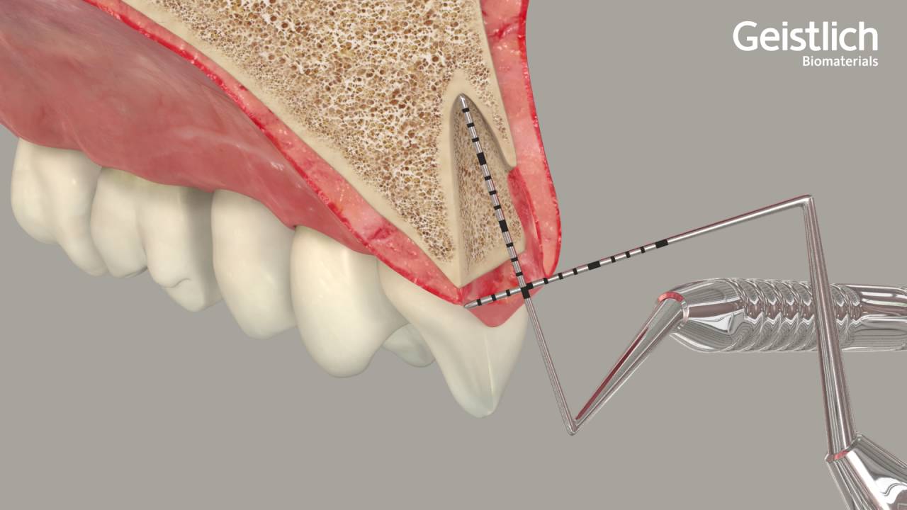 Socket Preservation Bone Graft Tooth Extraction