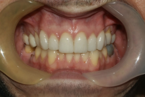 Veneer smile makeover after treatment by Dr Sara Chu