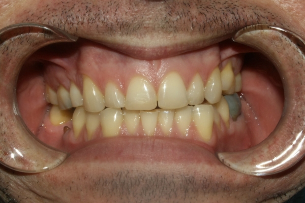 Veneer smile makeover before treatment by Dr Sara Chu