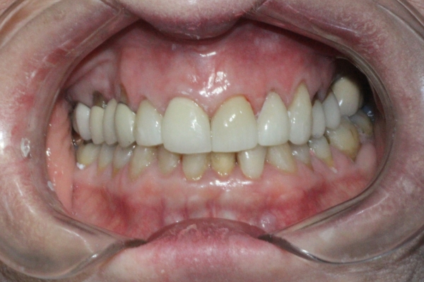 Porcelain veneers after treatment by Dr Sara Chu
