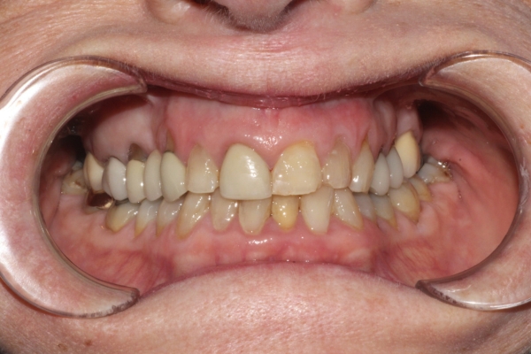 Porcelain veneers before treatment by Dr Sara Chu