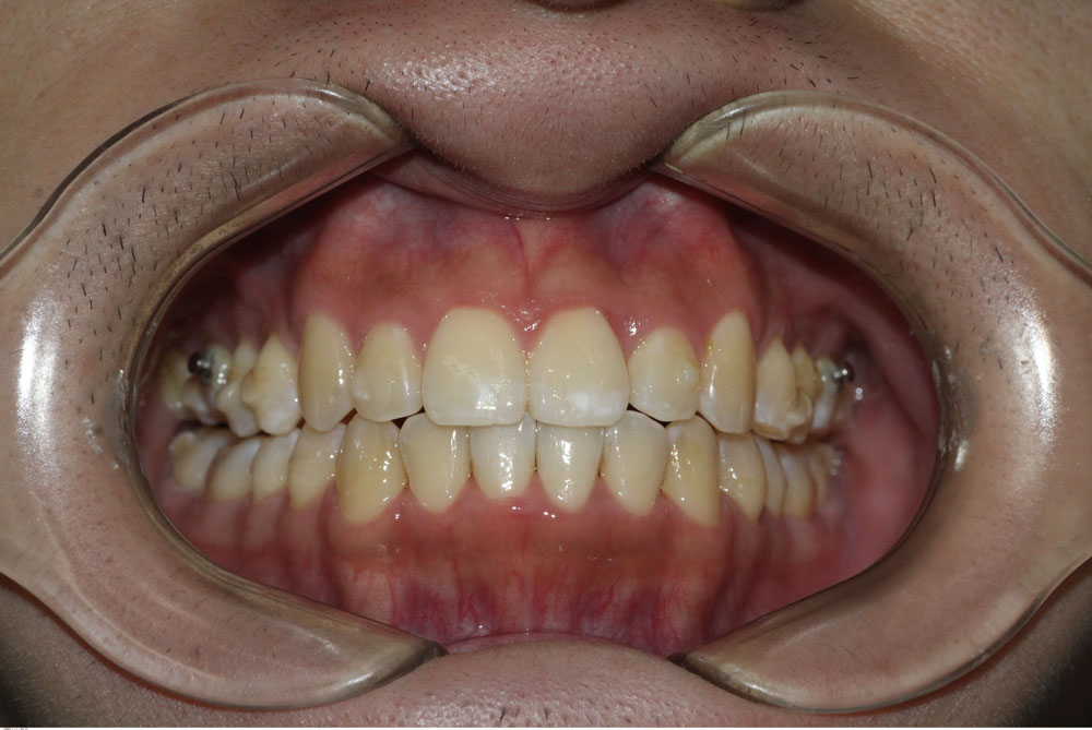Orthodontic smile correction after treatment by Dr Sara Chu
