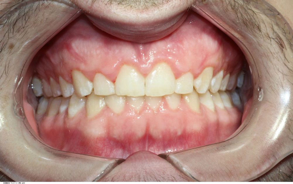Smile alignment after treatment by Dr Sara Chu