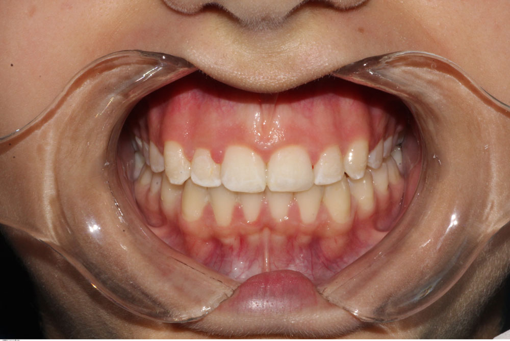 Orthodontic alignment after treatment by Dr Sara Chu