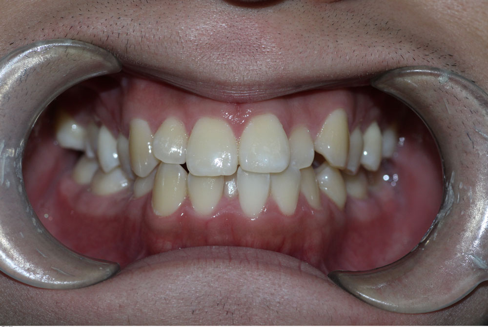 Orthodontic smile correction before treatment by Dr Sara Chu