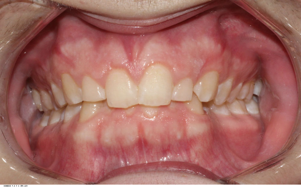 Smile alignment before treatment by Dr Sara Chu