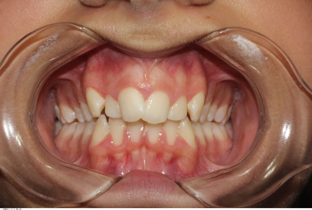 Orthodontic alignment before treatment by Dr Sara Chu