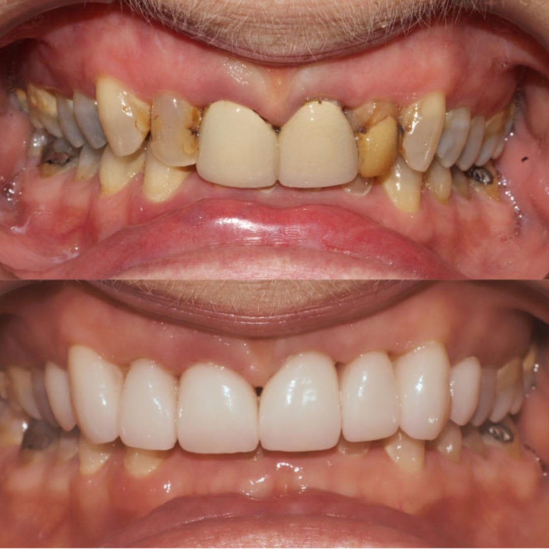 Crown and veneer transformation by Dr Phillip Mak