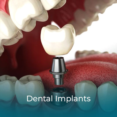 Dental Implants