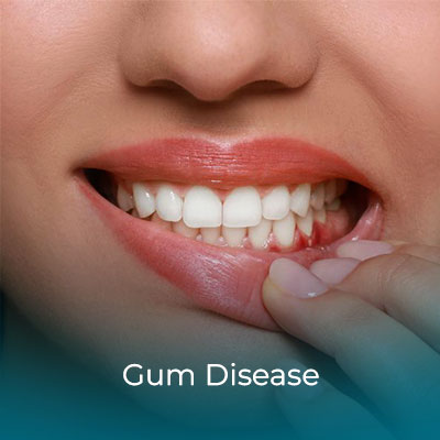 Gum Disease