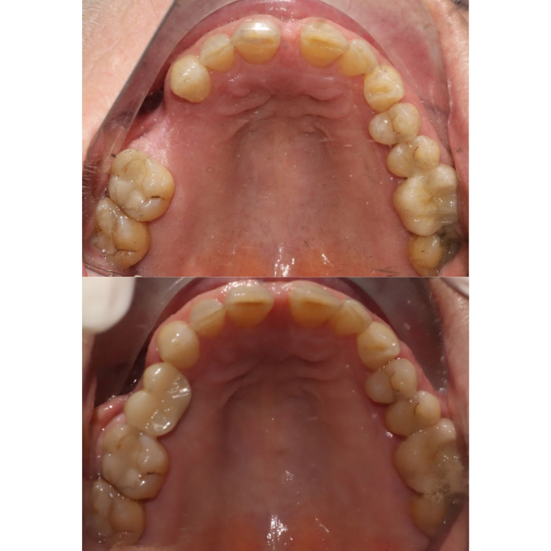 Dental implant transformation by Dr Phillip Mak