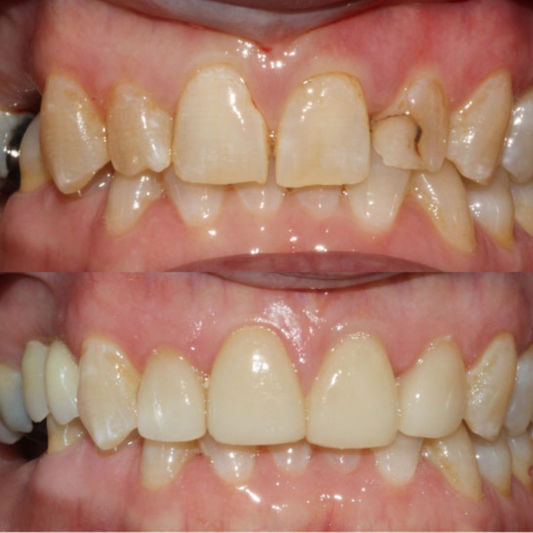 Implant and veneer transformation by Dr Phillip Mak