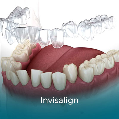 Invisalign