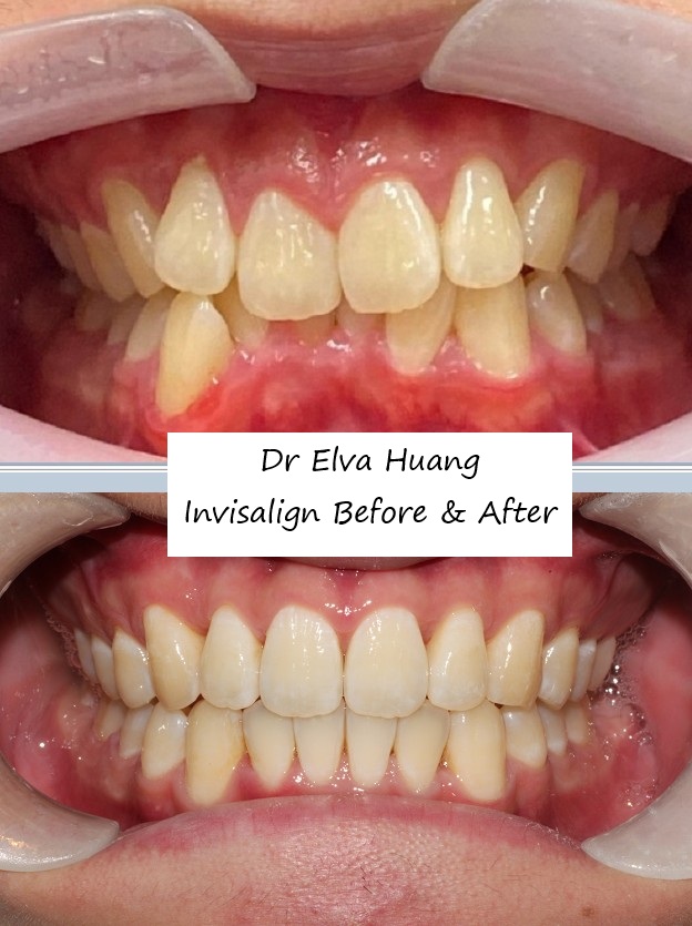 Invisalign smile transformation by Dr Elva Huang