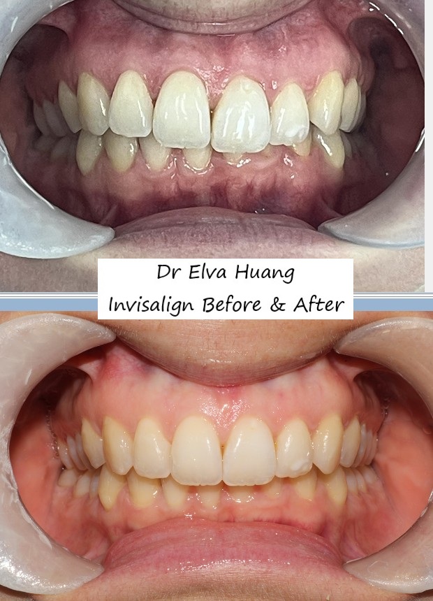 Correcting uneven anterior deep bite with Invisalign by Dr Elva Huang