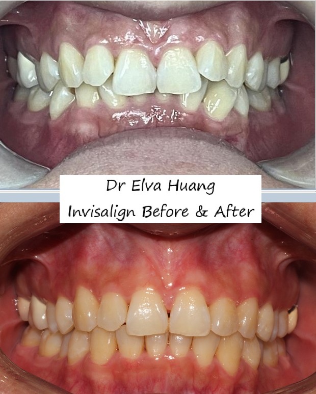Invisalign smile transformation by Dr Elva Huang