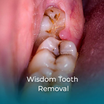 Wisdom Tooth Removal