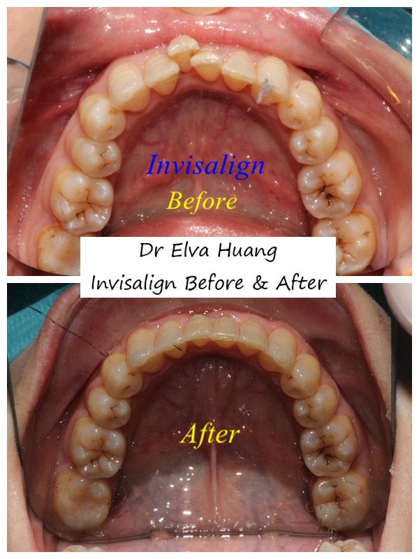 Invisalign smile transformation by Dr Elva Huang