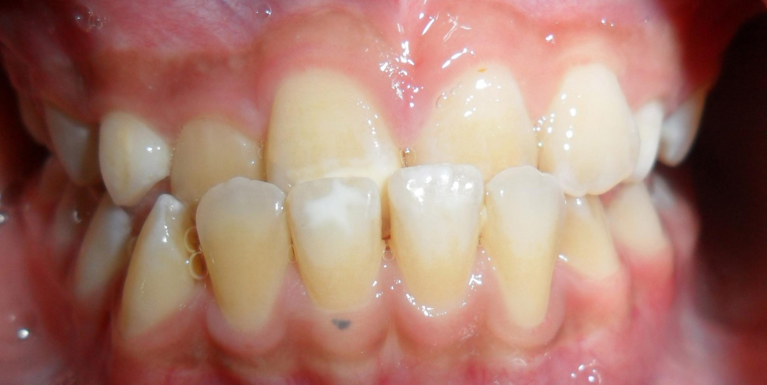 Class III crossbite before treatment