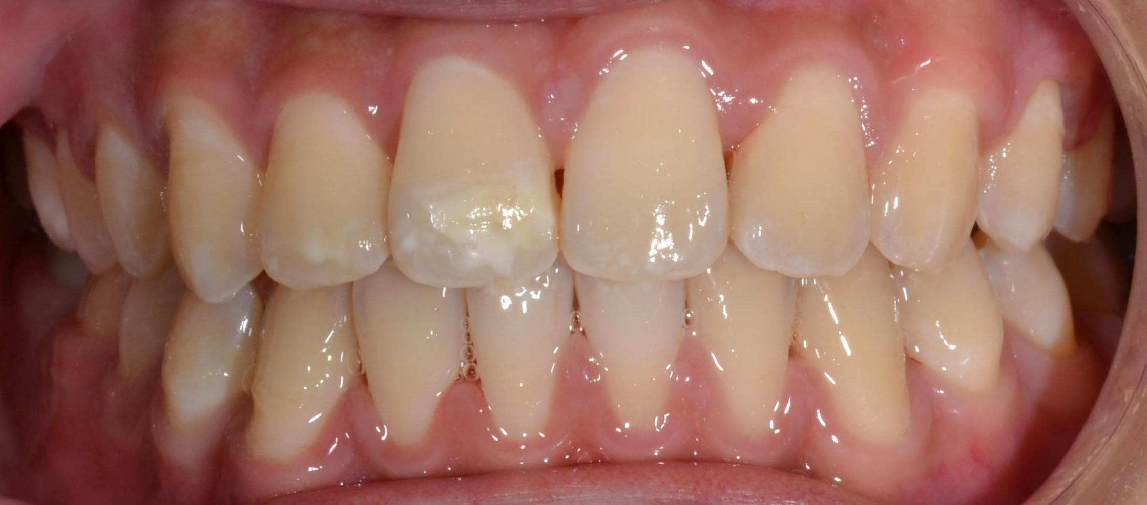 Class III crossbite after treatment