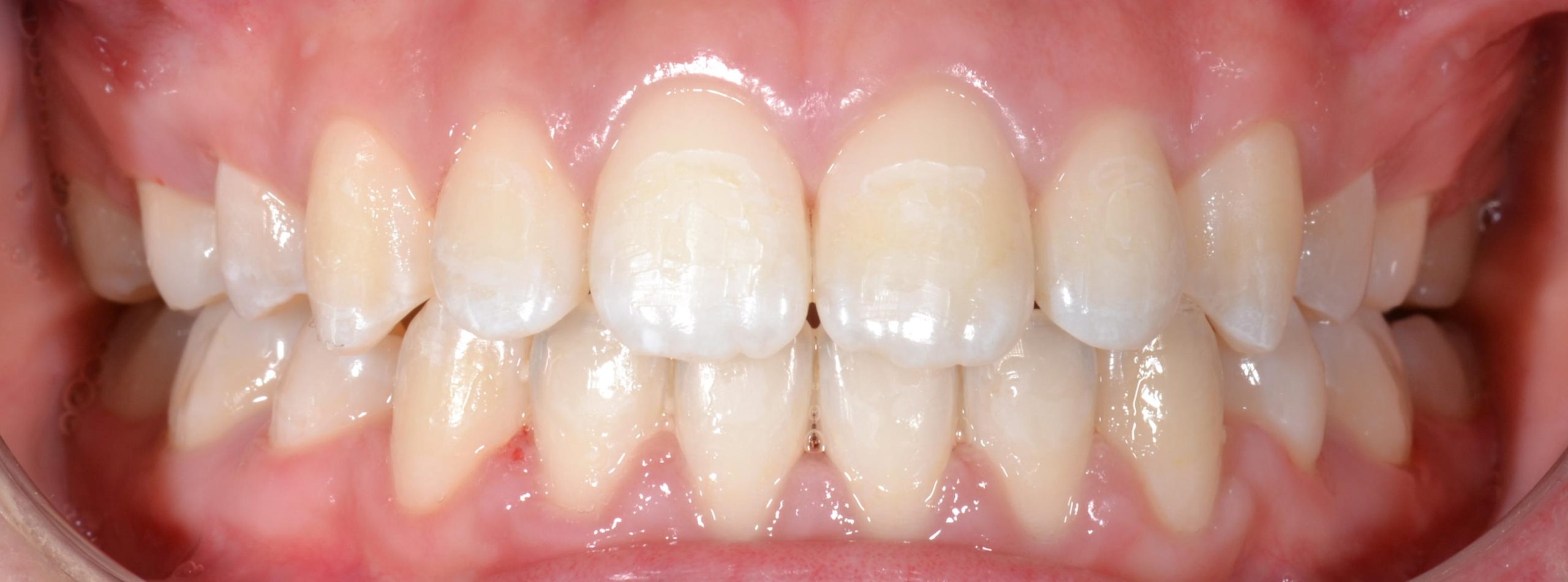 Braces alignment after treatment