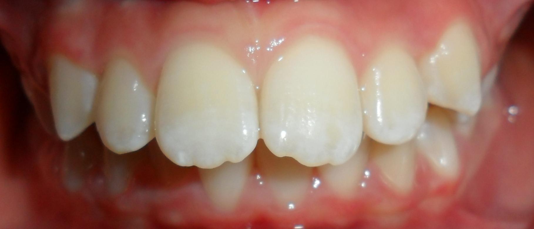 Braces alignment before treatment