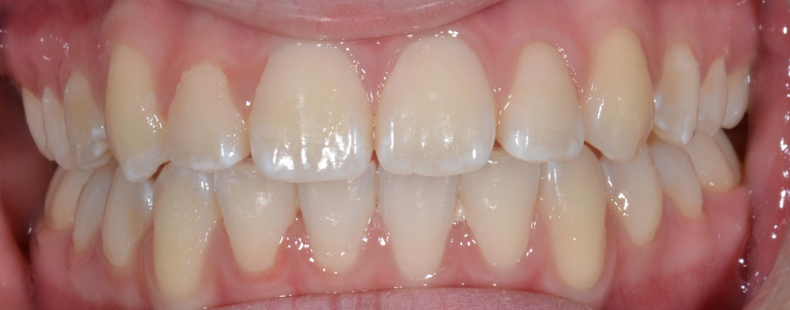 Smile alignment after braces