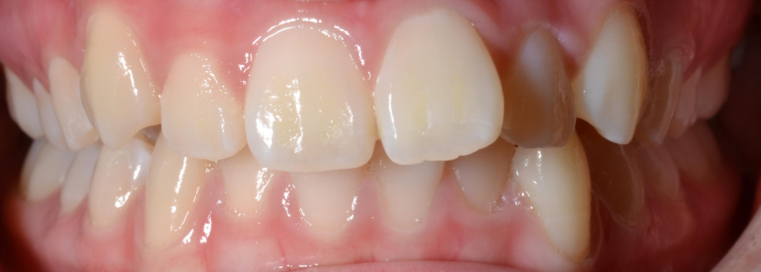 Smile alignment before braces