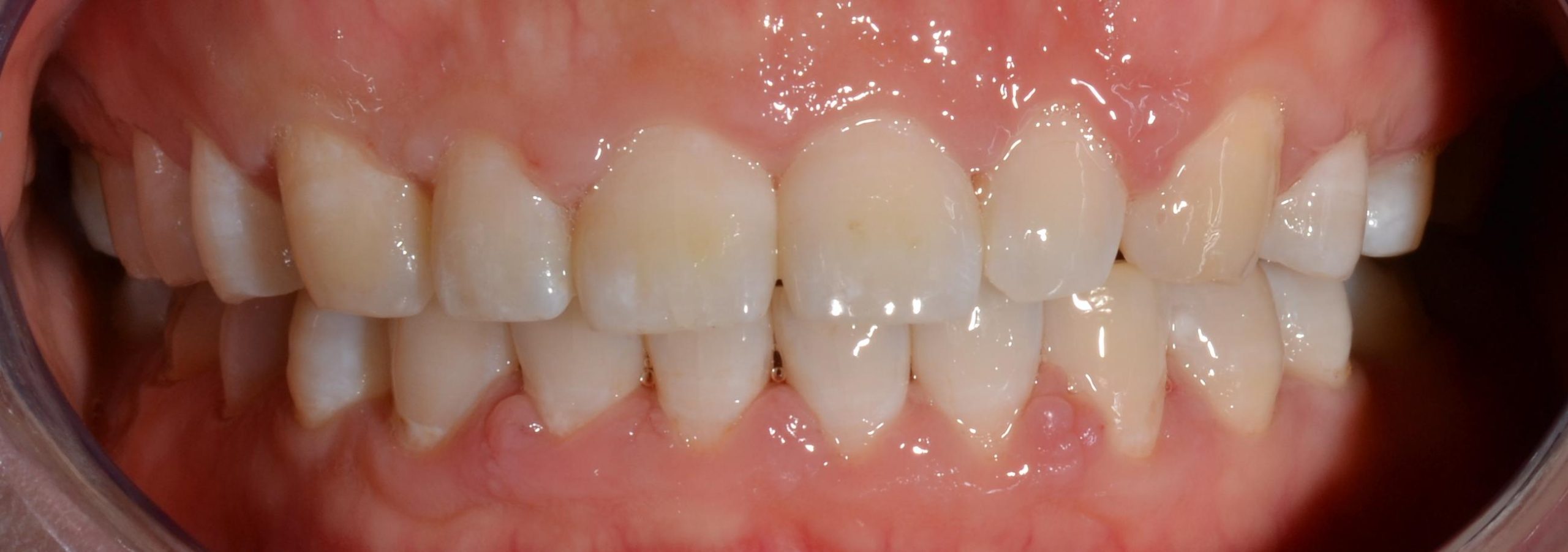 Orthodontic alignment after braces