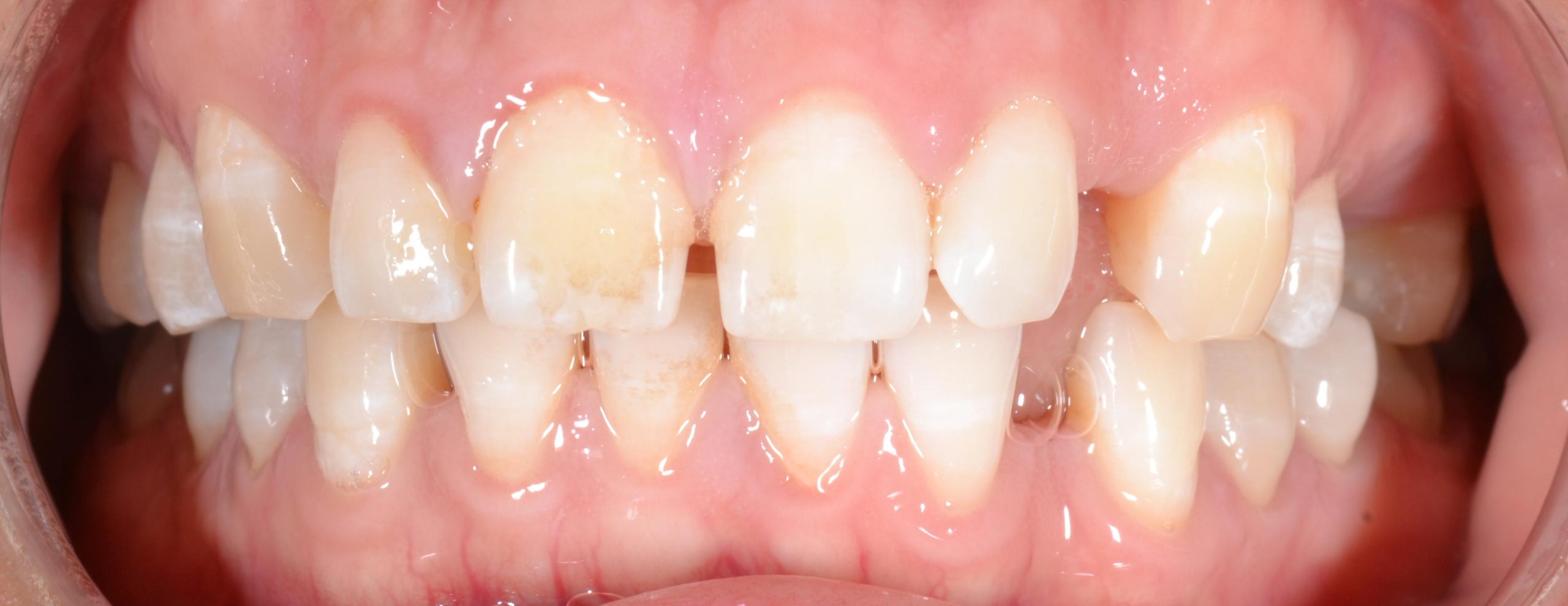 Orthodontic alignment before braces
