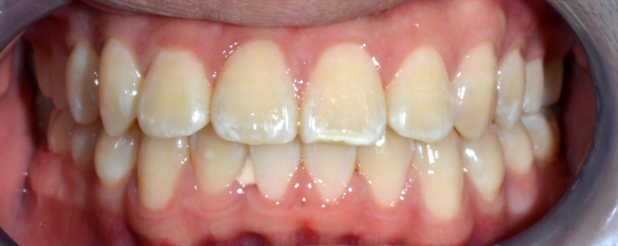 Class II crowding after braces