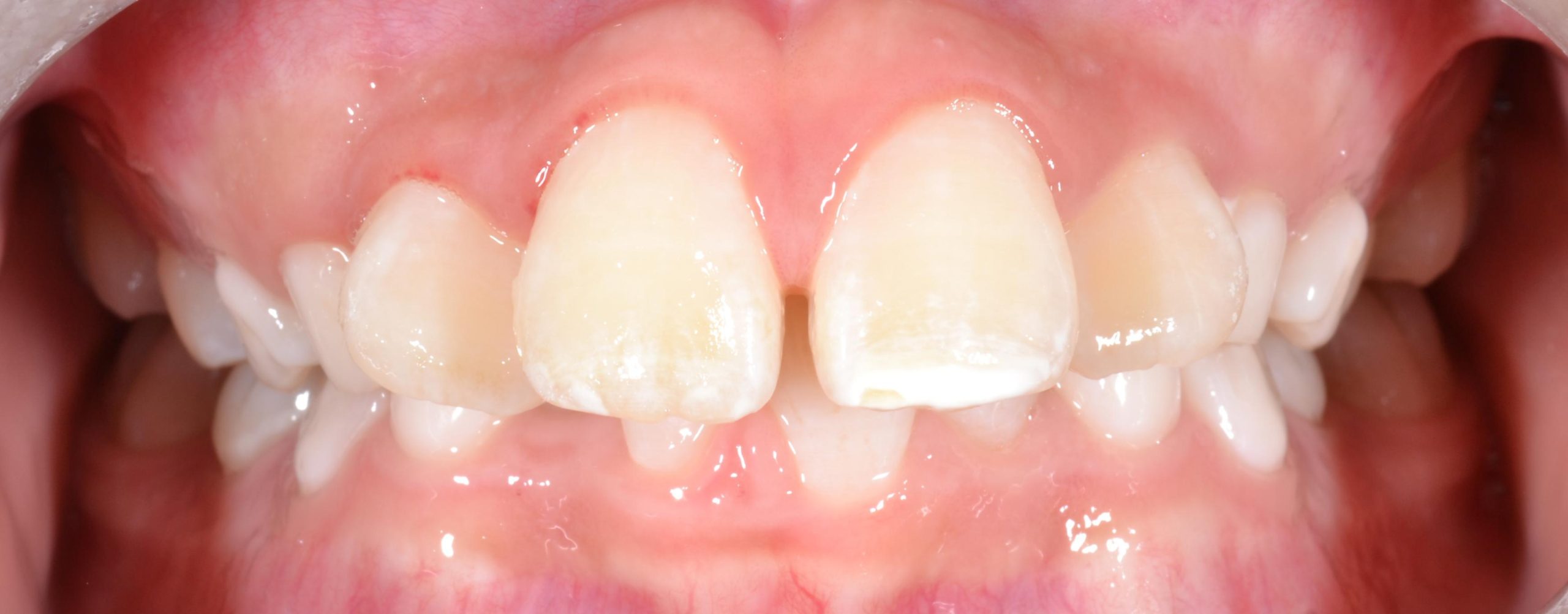 Class II crowding before braces