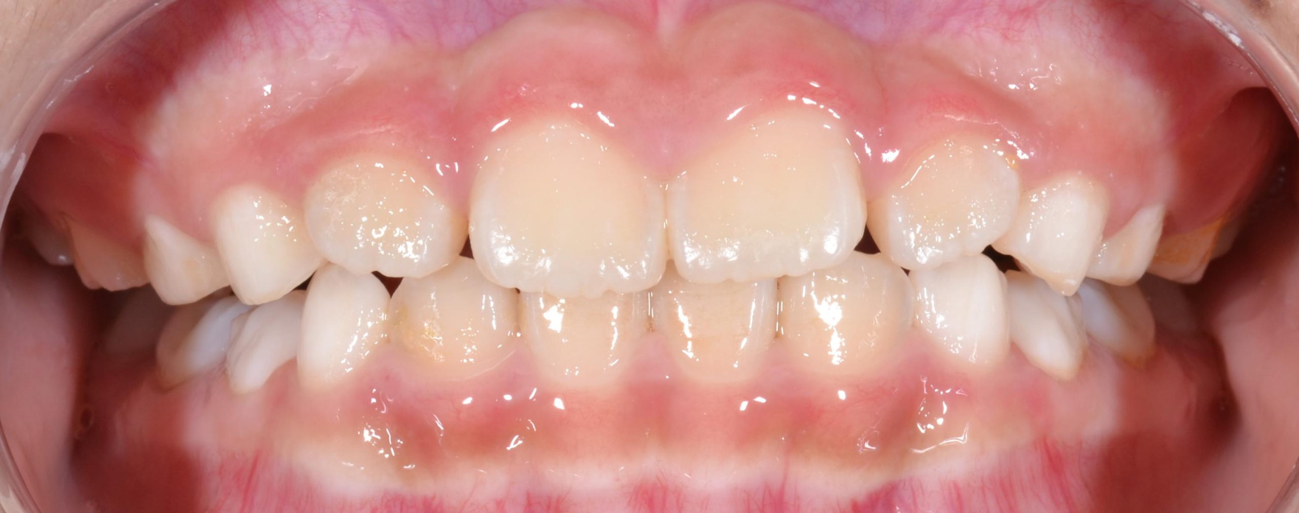Underbite after braces
