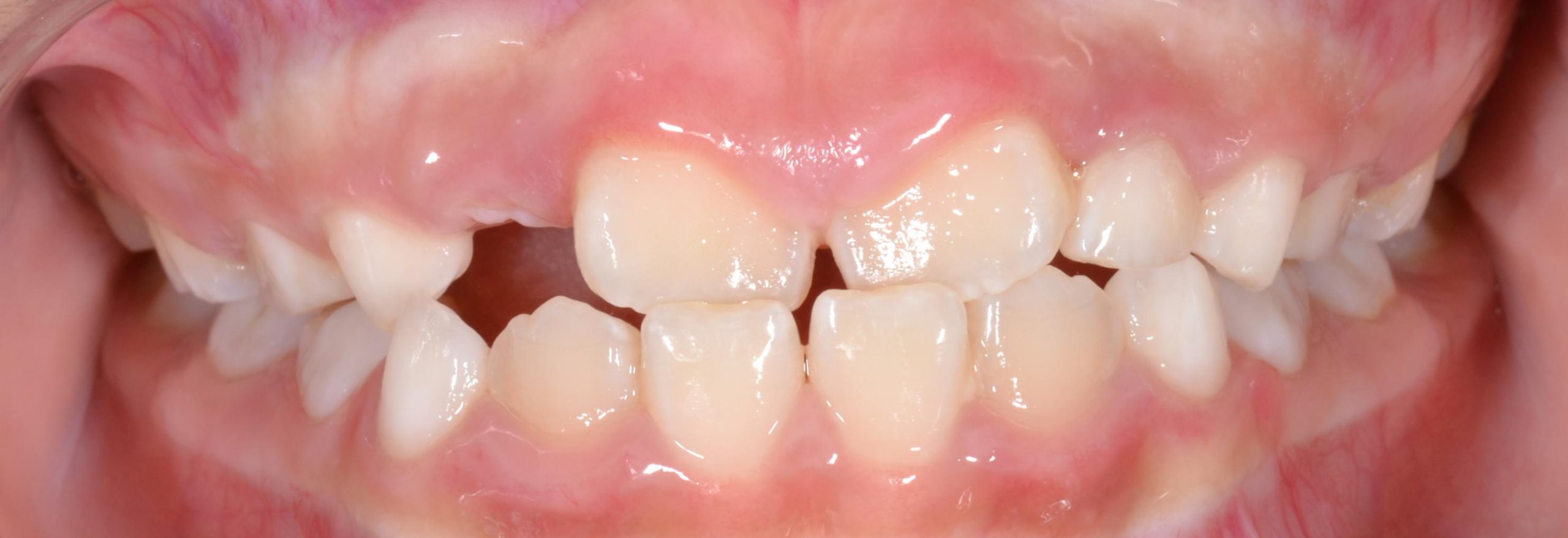 Underbite before braces