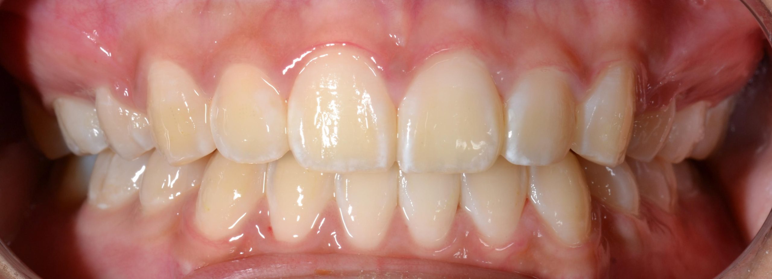 Class II protrusion after braces