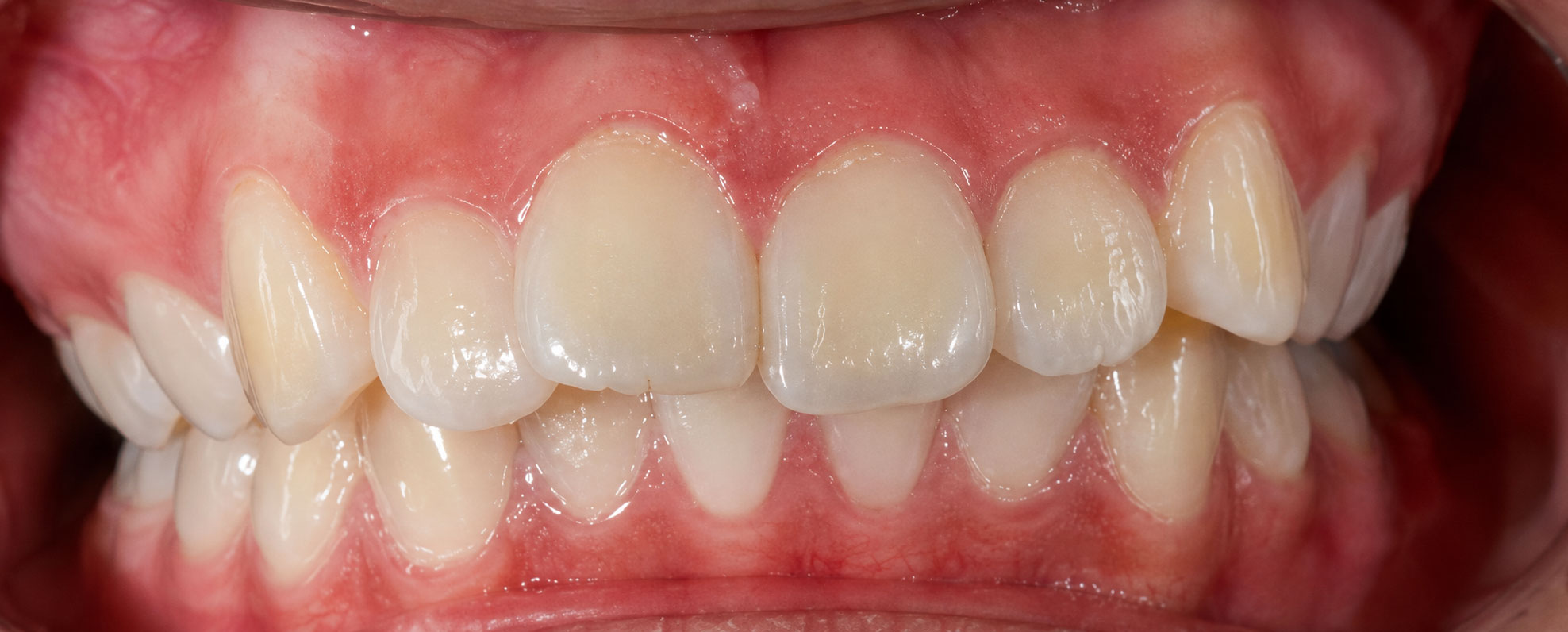 Class II protrusion before braces