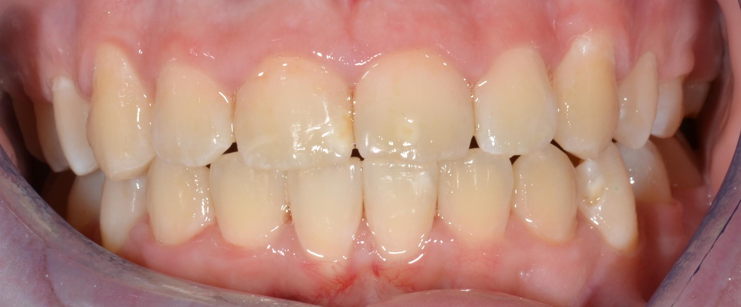 Crowding after braces