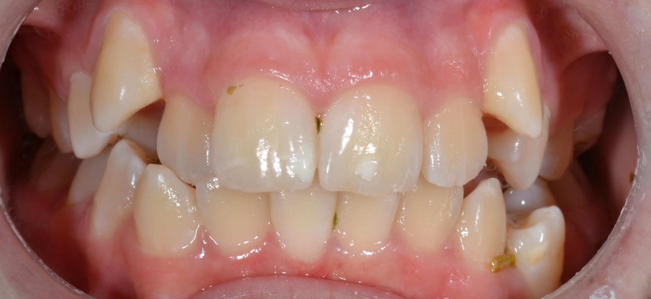 Crowding before braces