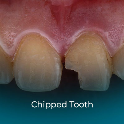 Chipped Tooth