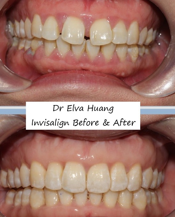 Closing gaps between teeth with Invisalign by Dr Elva Huang
