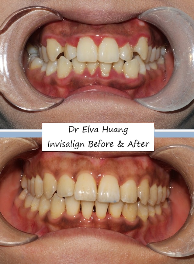 Correcting teeth crowding with Invisalign by Dr Elva Huang
