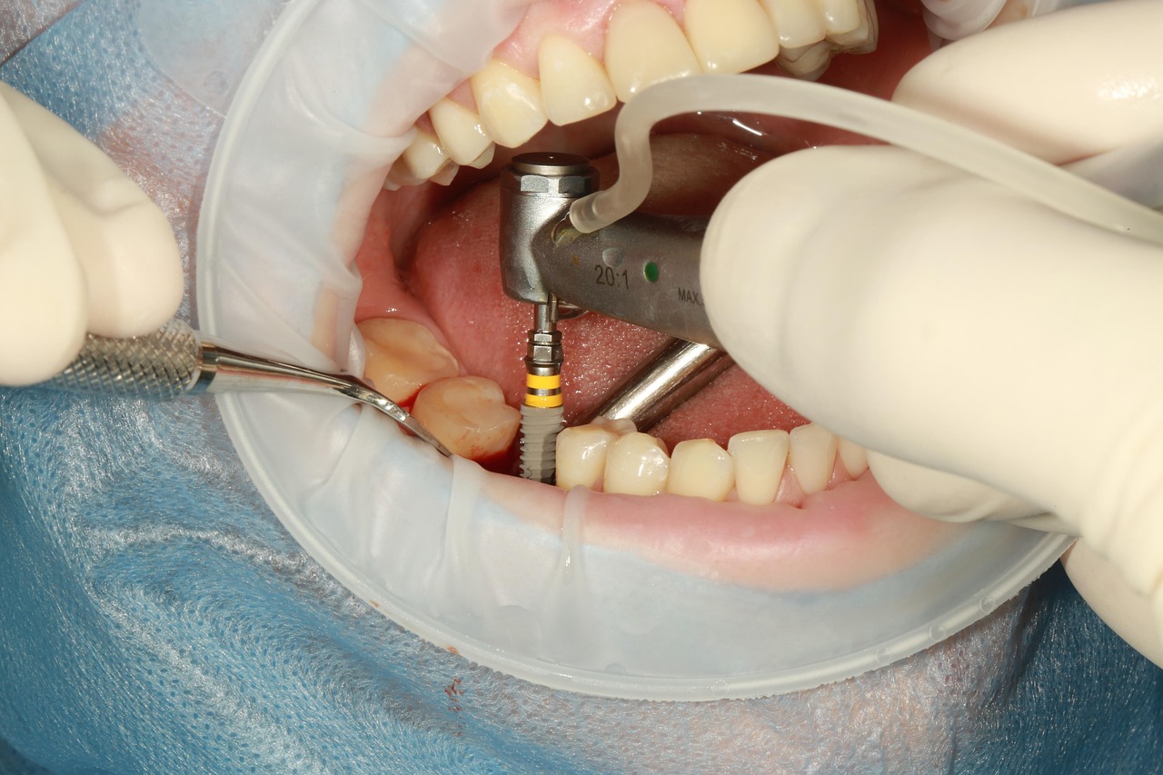 dental, implant, surgery, implant, implant, implant, implant, implant