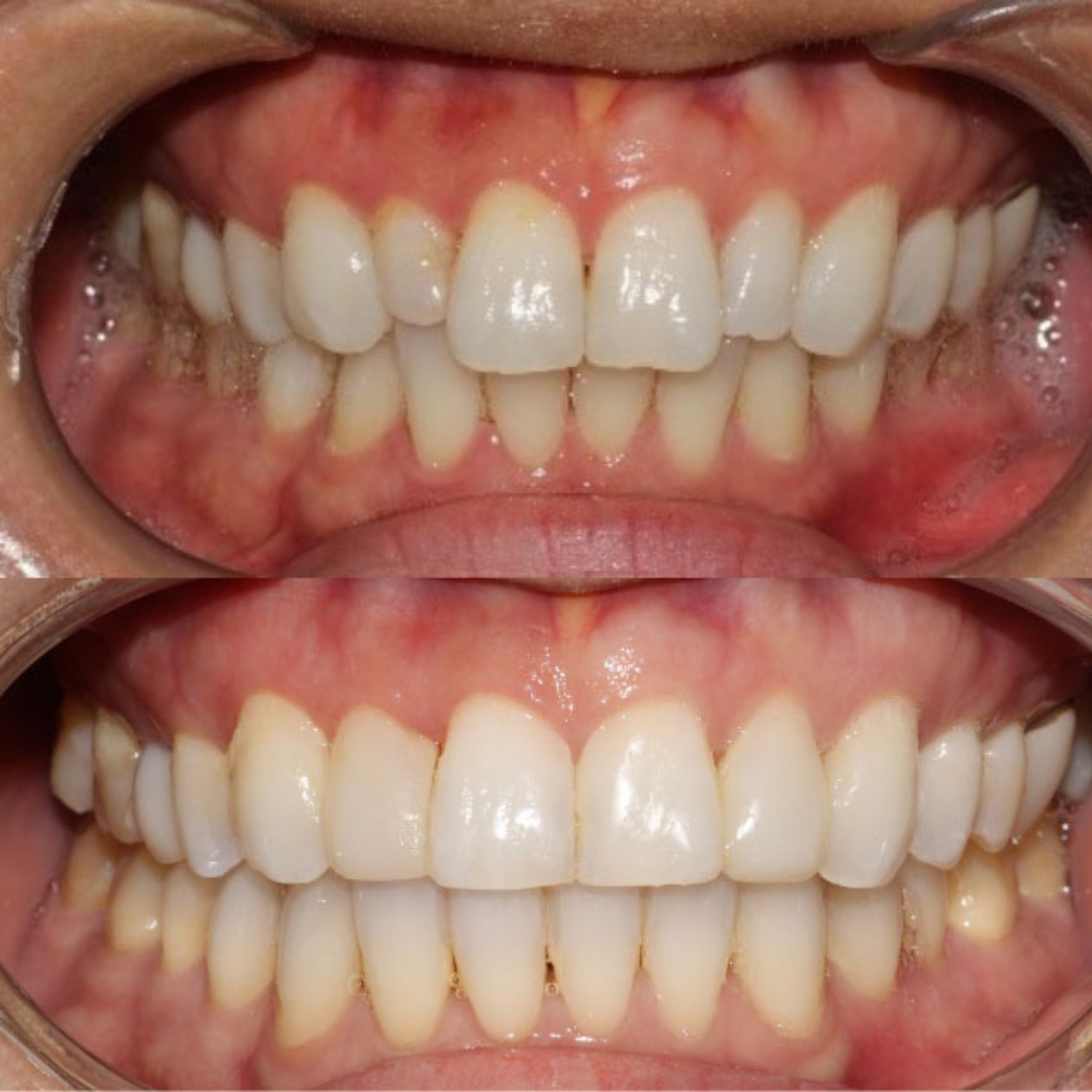 Invisalign bonding and whitening transformation by Dr Phillip Mak