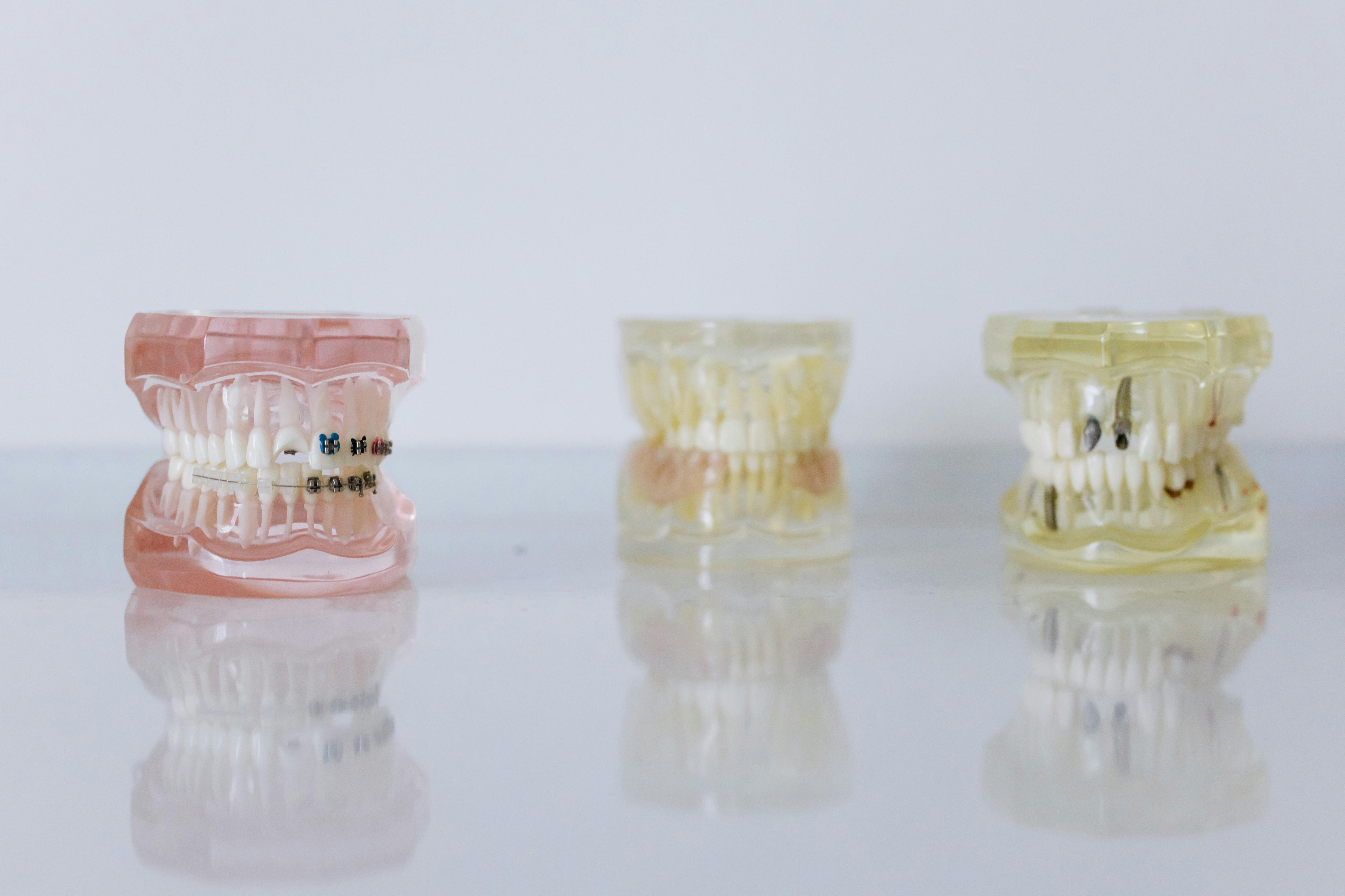 Close-up of dental models displaying braces and dentures for orthodontic education.