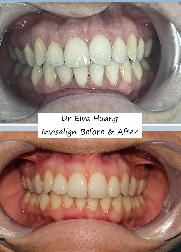 Correcting dental protrusion with Invisalign by Dr Elva Huang