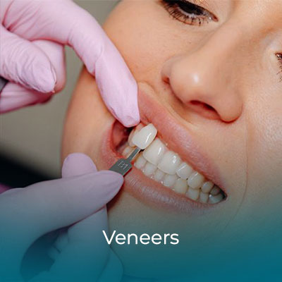 Veneers