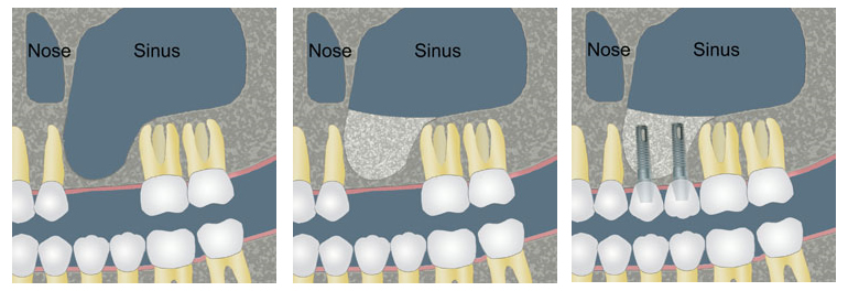 Sinus lift