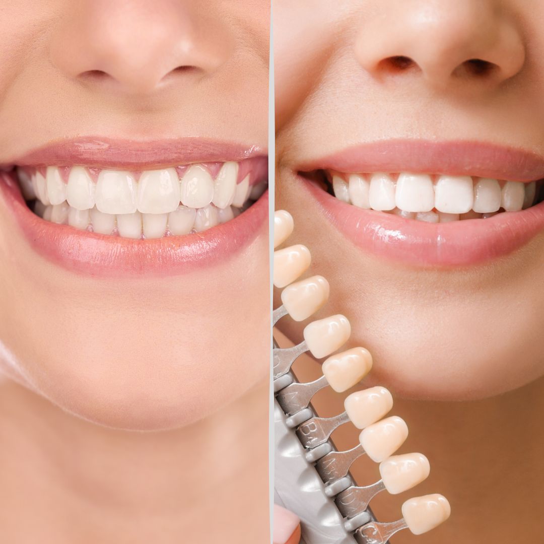 Composite Bonding Vs Veneers: Which Are Right For You?