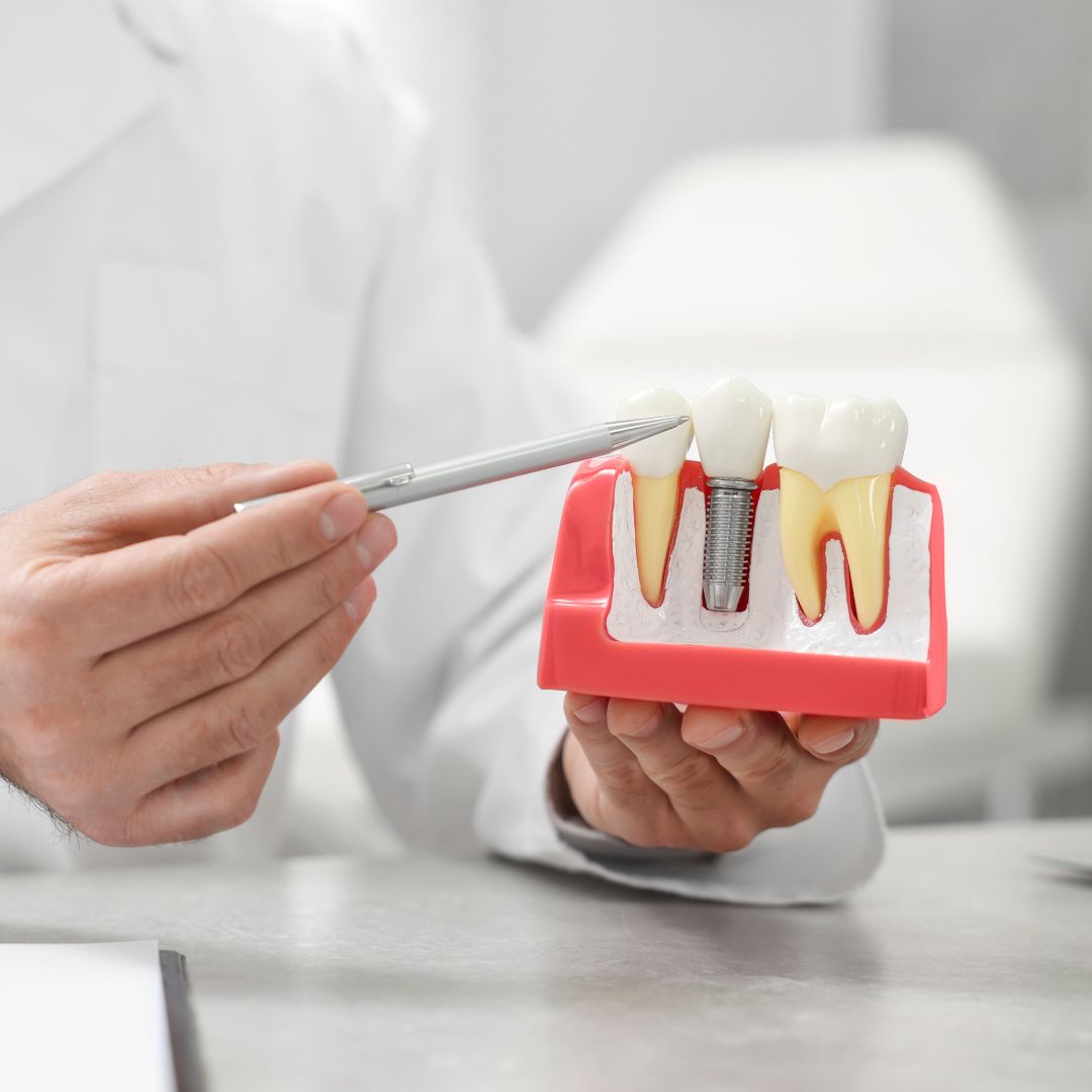 ALL ABOUT ALL-ON-4 IMPLANTS 