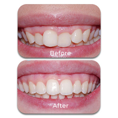 INVISALIGN VS BRACES